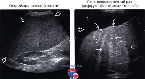 Умеренные диффузные изменения эхоструктуры печени: