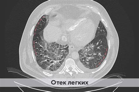 Уплотнение костальной плевры