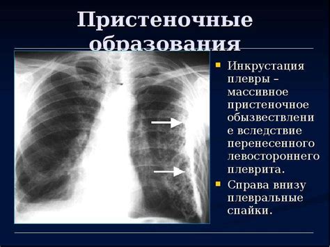 Уплотнение паракостальной плевры: причины и факторы риска