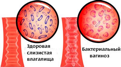 Уреаплазмы и бактериальный вагиноз у мужчин: причины и последствия