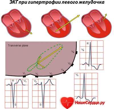 Усиление потенциалов левого желудочка