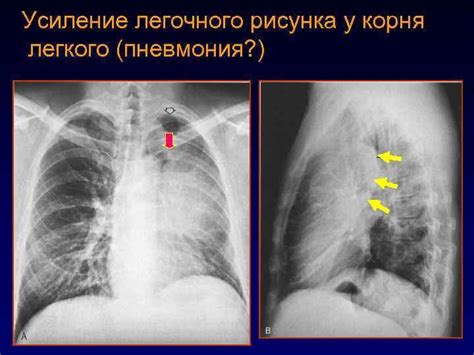 Усиленный сосудистый рисунок легких у взрослых