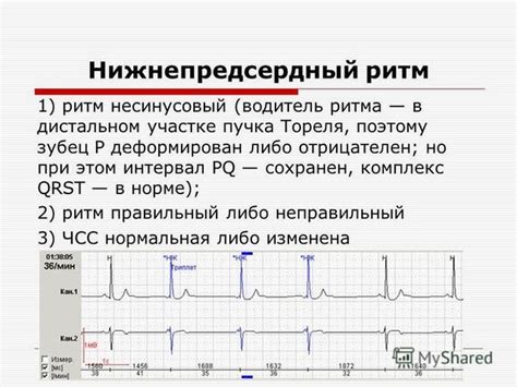 Ускоренный нижнепредсердный ритм