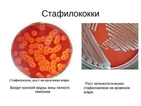 Условно патогенная флора: стафилококк ауреус