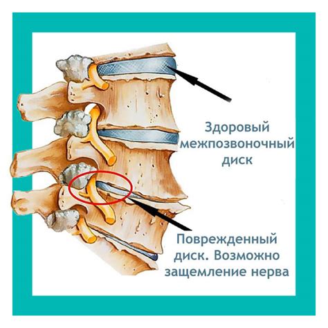 Ущемление нерва