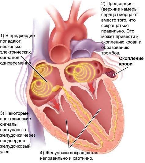 Факторы, влияющие на появление наджелудочкового ритма