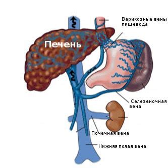 Факторы, влияющие на расширение селезеночной вены