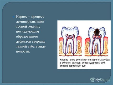 Факторы, способствующие возникновению кариеса и разрушению зубной эмали