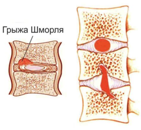 Факторы, способствующие появлению грыжи шморля