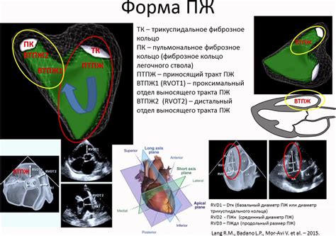 Факторы риска для перегрузки правого желудочка