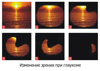 Факторы риска для развития глаукомы глаз