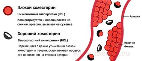 Факторы риска повышения уровня холестерина ЛПНП