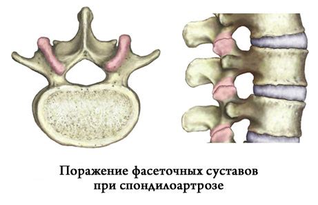 Факторы риска появления спондилоартроза