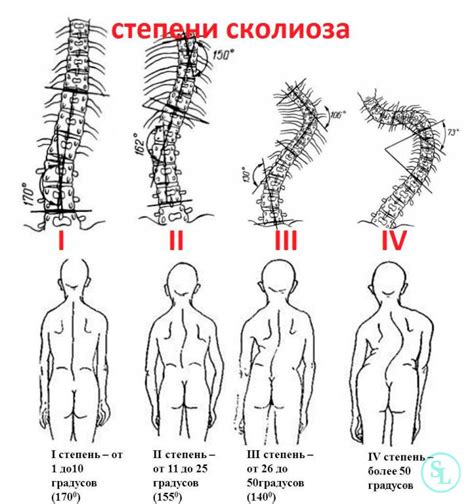 Факты о существовании разных типов сколиоза