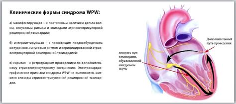 Феномен WPW: его влияние и особенности