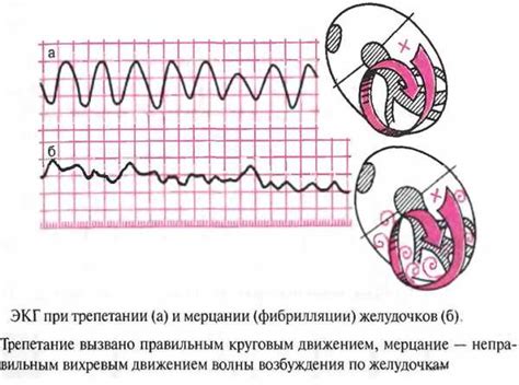 Фибрилляция желудочков: основная информация