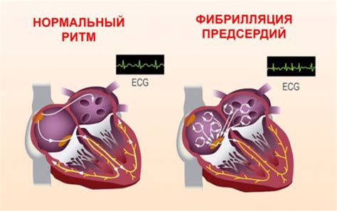 Фибрилляция предсердий: причины, симптомы и лечение