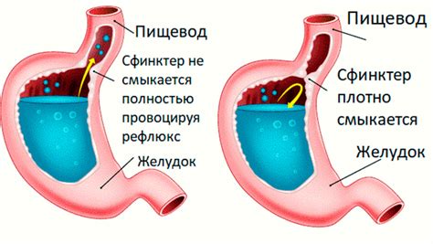 Фибрин в пищеводе: симптомы и последствия