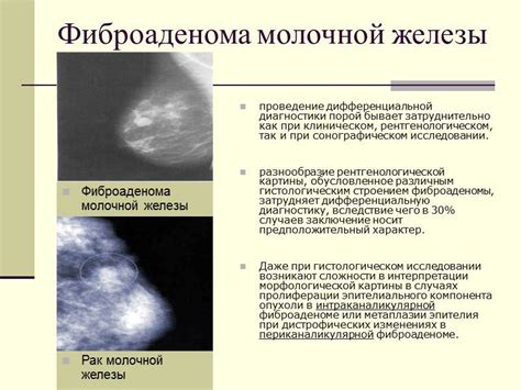 Фиброаденома: когда необходима операция на молочной железе