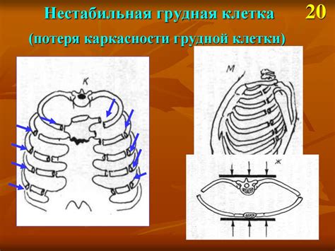 Физиологические изменения, приводящие к нарушению каркасности грудной клетки