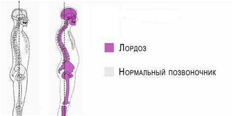 Физиологический лордоз у ребенка и его значение