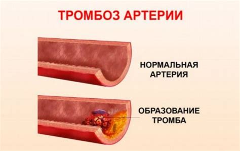 Физиотерапия при тромбозе мозговых артерий