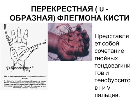 Флегмона: эффективные методы лечения