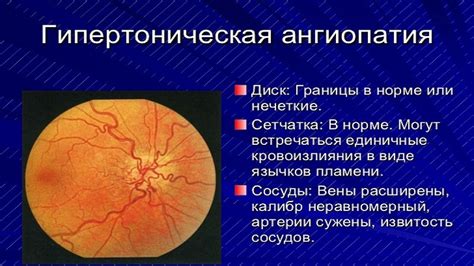 Фоновая ангиопатия сетчатки обоих глаз