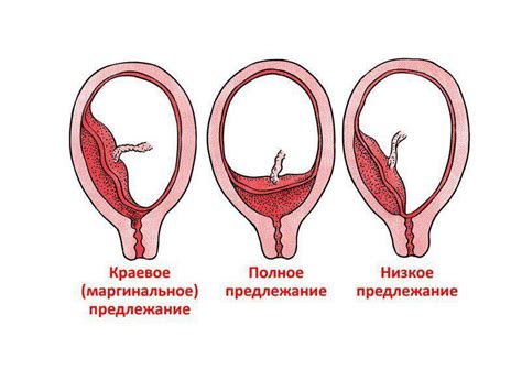 Формирование плаценты по задней стенке