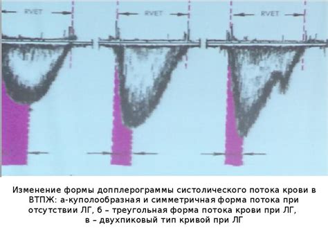 Формирование систолического потока