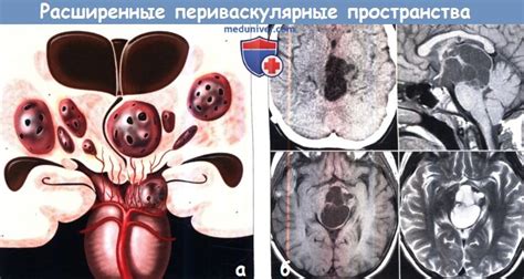 Функции расширенных периваскулярных пространств