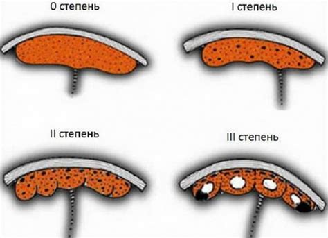 Характеристики и особенности плаценты в степени созревания 2