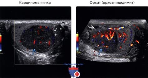 Характеристики очагового образования при УЗИ