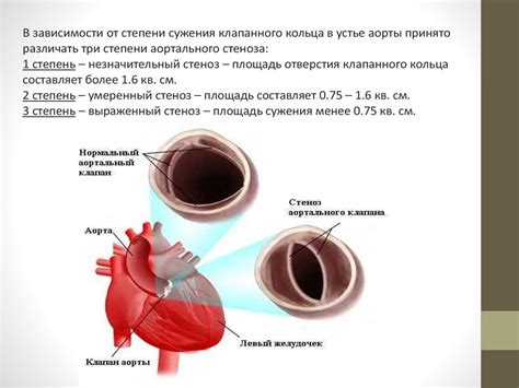 Хирургические методы лечения недостаточности клапанов МПВ