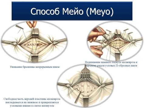 Хирургические методы лечения отслойки от передней стенки