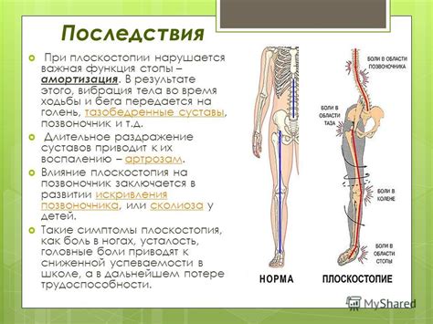 Хирургическое вмешательство при плоскостопии: возможности и последствия