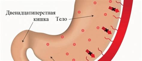 Хирургическое лечение гастропатии папулезной