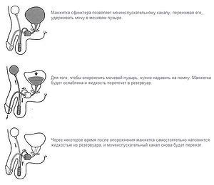 Хирургическое лечение гипотонии мочевого пузыря