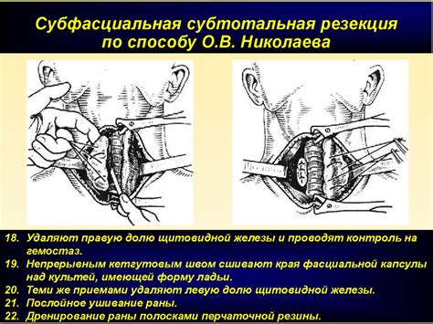 Хирургическое лечение крупнозернистой эхоструктуры щитовидной железы