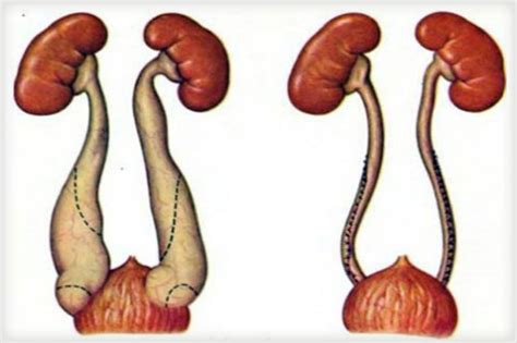 Хирургическое лечение мегауретера