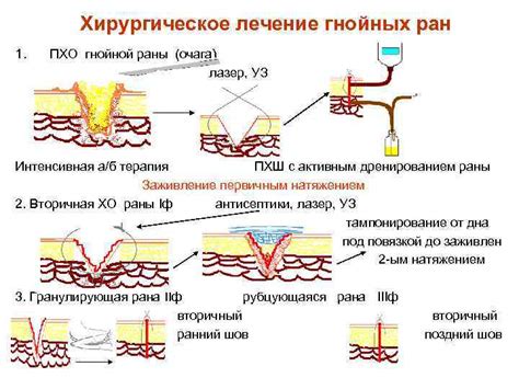 Хирургическое лечение проксимальной раны