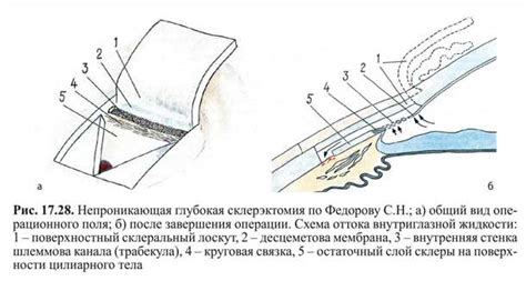 Ход процедуры непроникающей глубокой склерэктомии