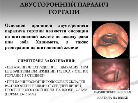 Хронические заболевания гортани