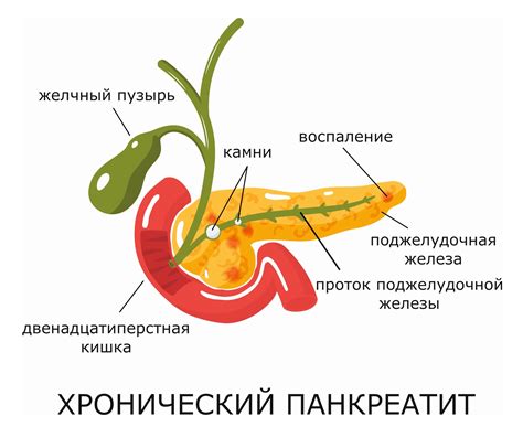 Хронический панкреатит: причины, симптомы, лечение