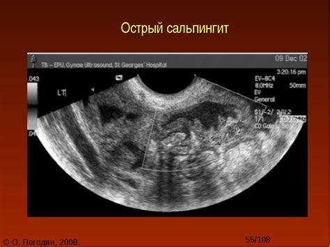 Хронический сальпингит вне обострения