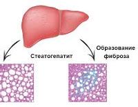 Хронический стеатогепатит: симптомы, причины и лечение