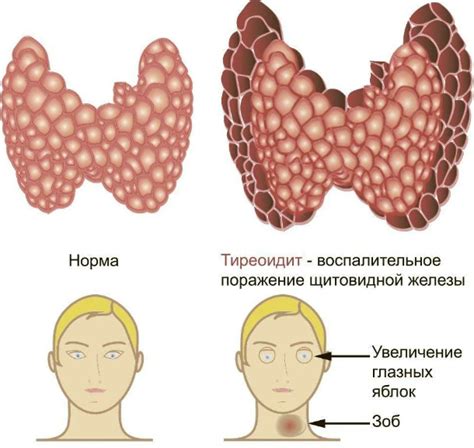 Хронический тиреоидит щитовидной железы