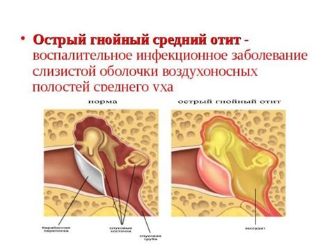 Хроническое среднее отитное воспаление