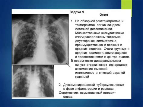 Цели и задачи обзорной рентгенографии легких