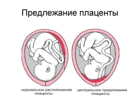 Центральное предлежание плаценты: определение и значение